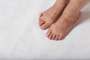 Correcting Hammertoe