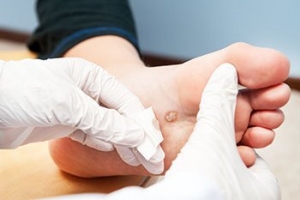 Transmission of Plantar Warts
