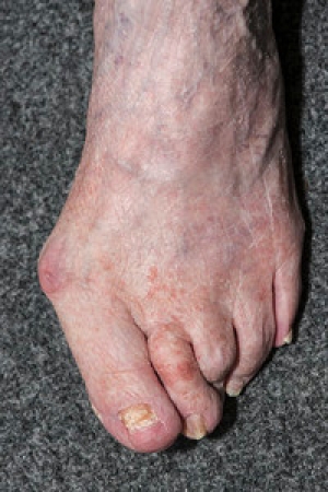 What Can Cause a Bunion to Develop?