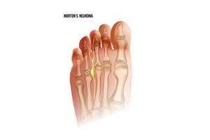 Morton’s Neuroma Is a Nerve Condition