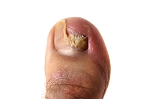 When to See a Doctor for a Broken Toenail