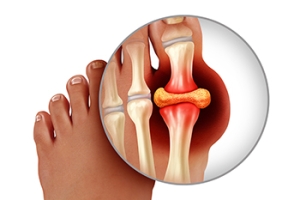 How Is Gout Diagnosed?