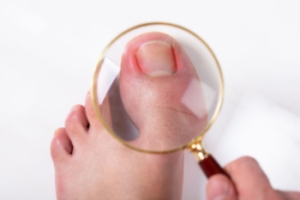 Understanding and Relieving Ingrown Toenails