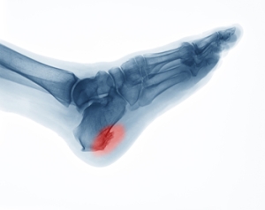 Dealing With a Heel Spur