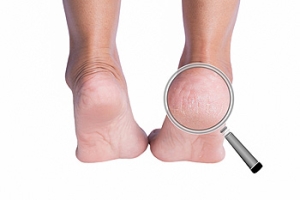 Why Are My Heels Cracked?