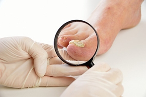 Fungal Nails 101