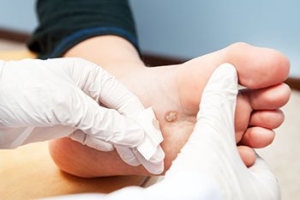 Do I Have a Plantar Wart?