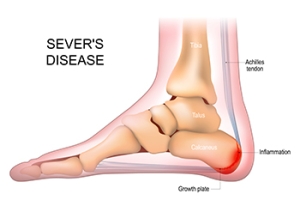 A Common Adolescent Foot Condition