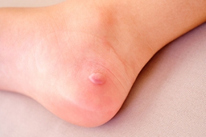 Popping of Foot Blisters